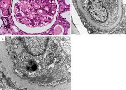 Renal pathologic findings in this COVID-19 patient