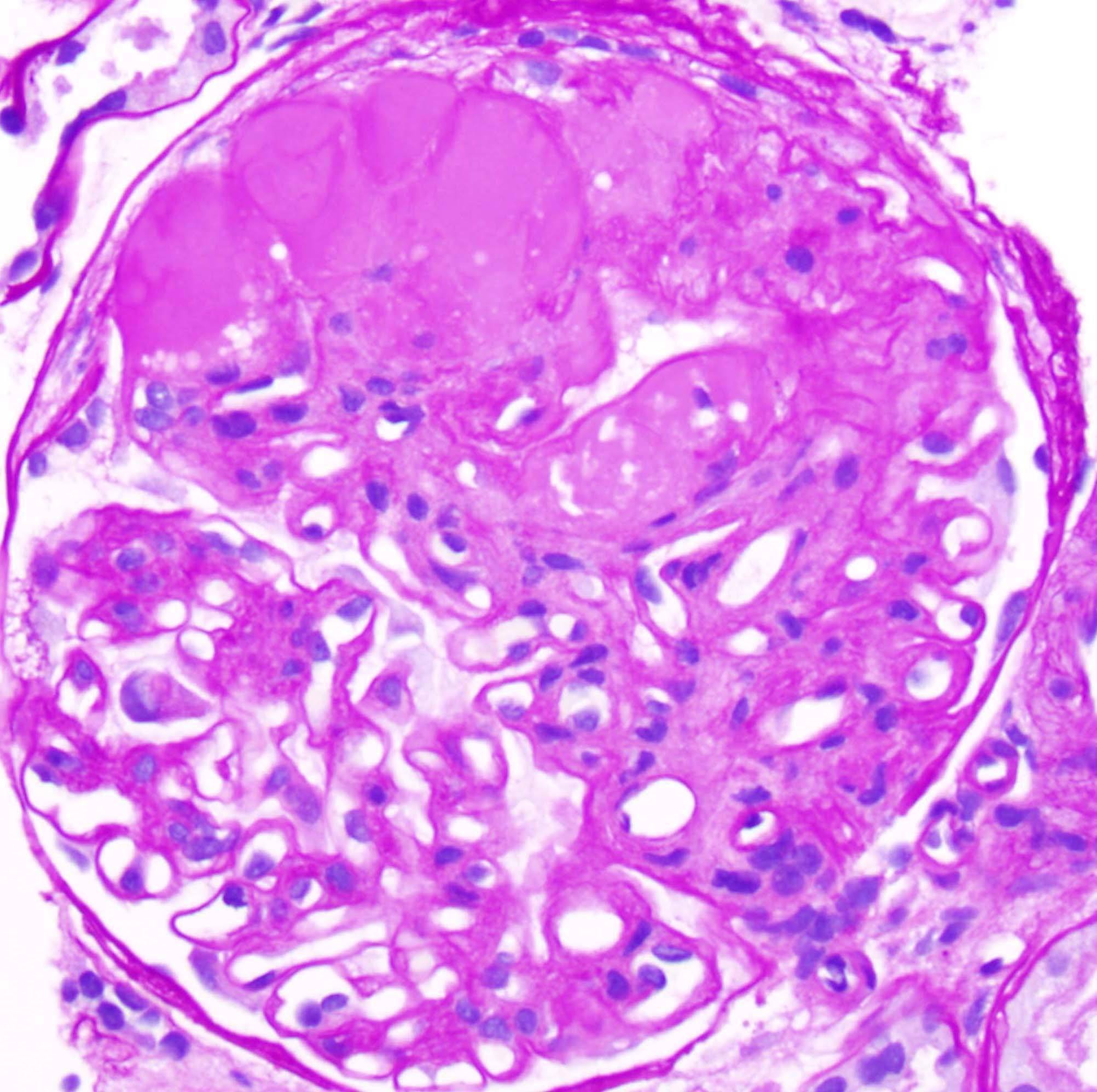 Focal Segmental Glomerulosclerosis (FSGS)