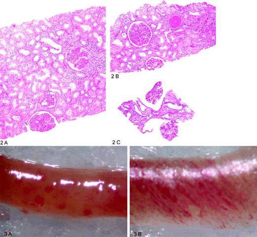 renal cortex matching to diagnostic image of renal biopsy