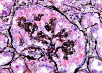 HIVAN (Collapsing Glomerulopathy) on Silver Stain