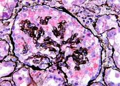 HIVAN (Collapsing Glomerulopathy) on Silver Stain