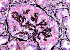 HIVAN (Collapsing Glomerulopathy) on Silver Stain