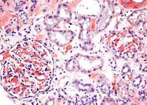 Clinical, morphologic, and genetic features of renal leukocyte chemotactic factor 2 amyloidosis
