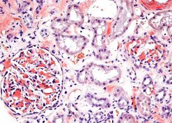 Clinical, morphologic, and genetic features of renal leukocyte chemotactic factor 2 amyloidosis