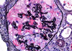 Apolipoprotein L1 risk variants