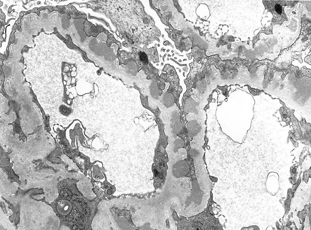 membranous glomerulopathy