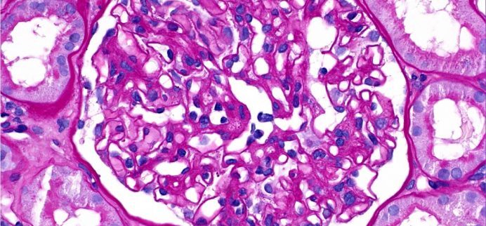glomerulus showing Mild mesangial hypercellularity in IgA nephropathy on PAS stain