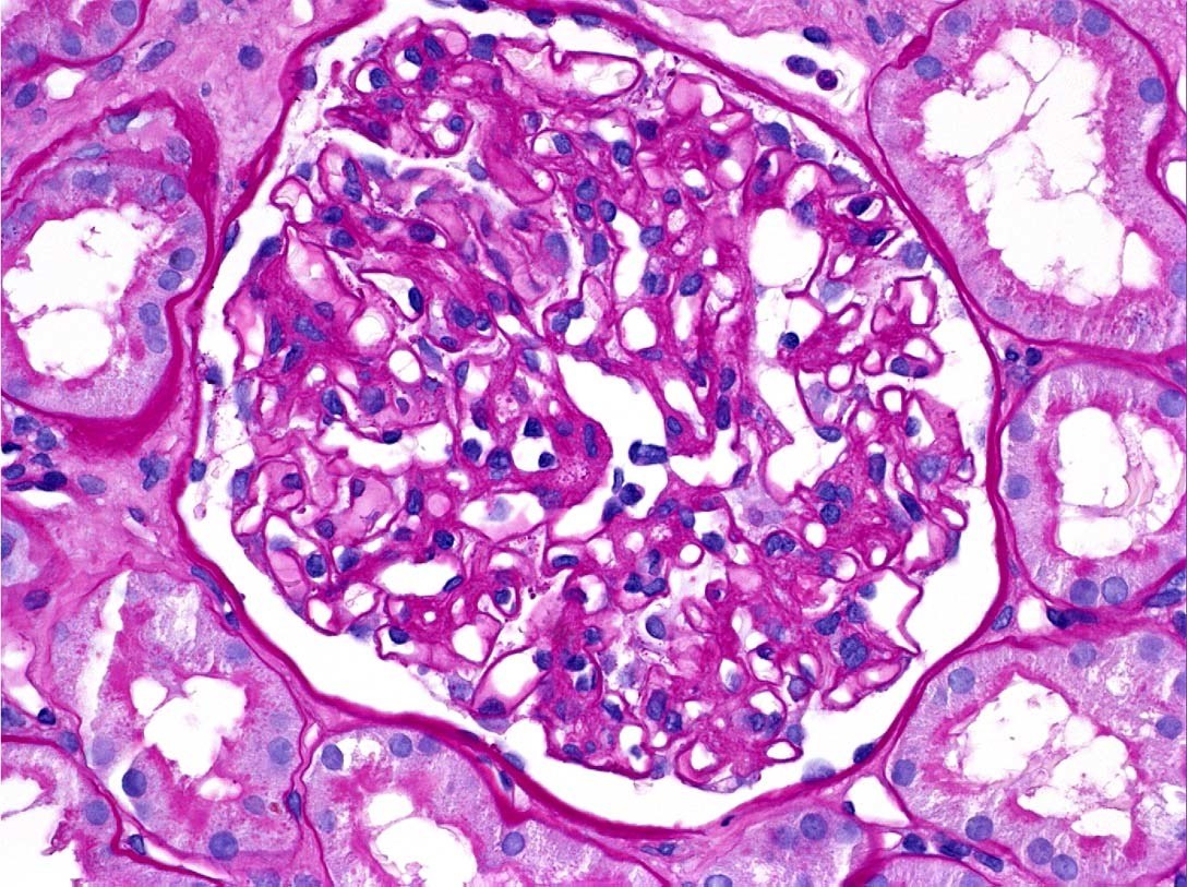 Mild mesangial hypercellularity in IgA nephropathy on PAS stain