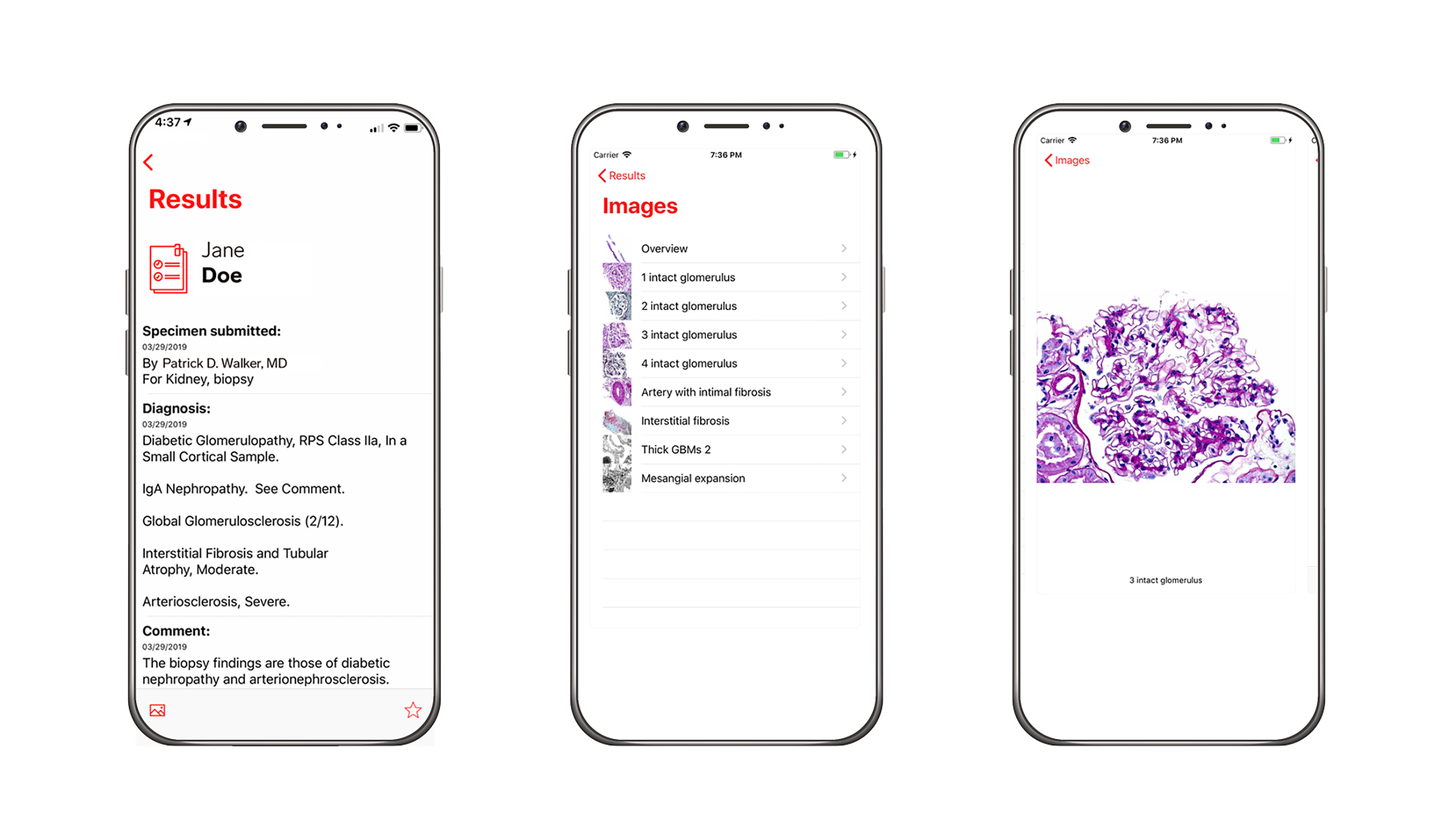 arkana labs connect app example showing results of biopsy and biopsy images taken by renal pathologists at arkana laboratories