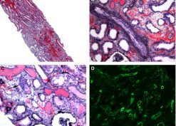 Kidney transplant biopsy findings