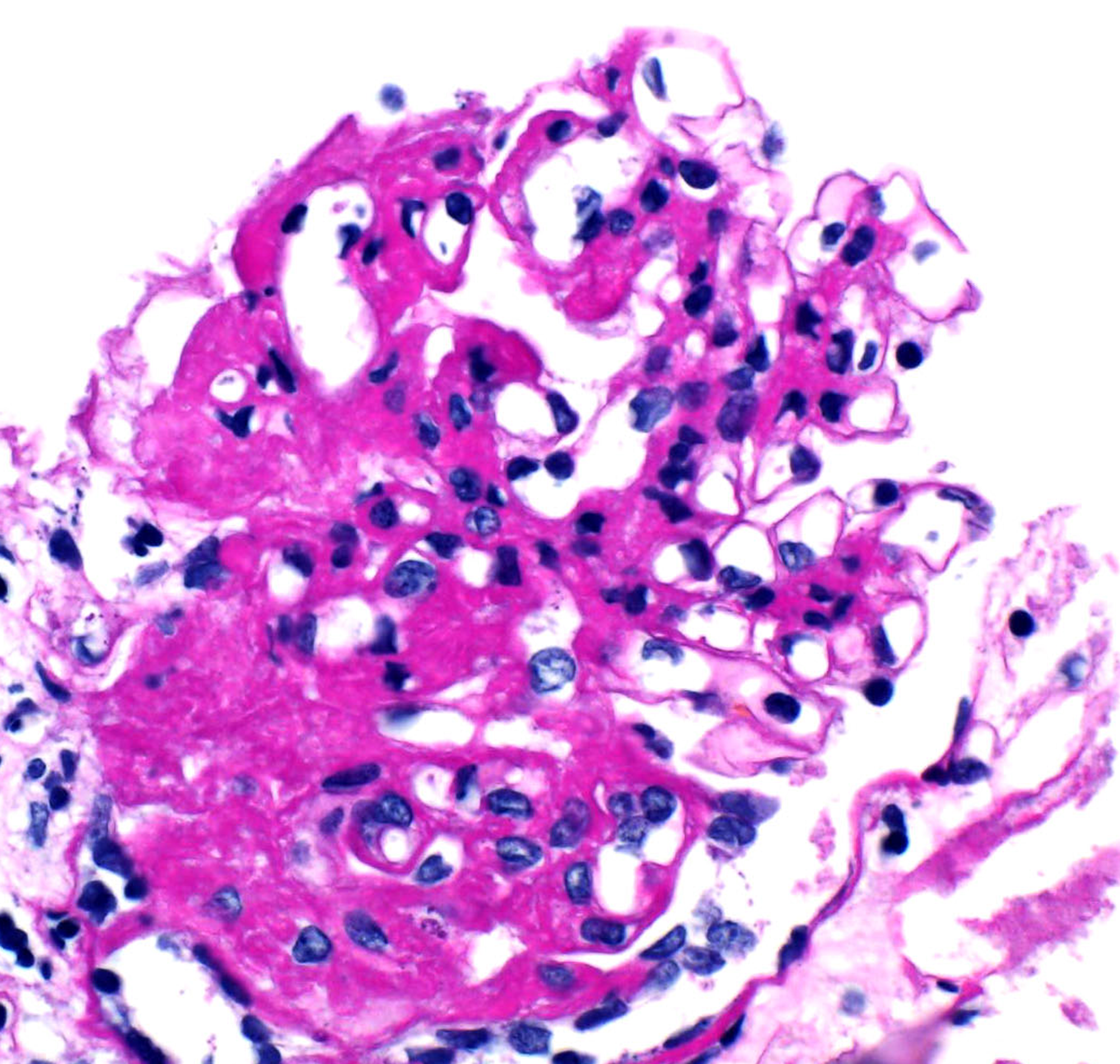 glomerulus from a renal biopsy taken by Arkana laboratories