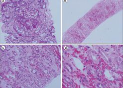 Medullary angiitis and pauci-immune crescentic glomerulonephritis