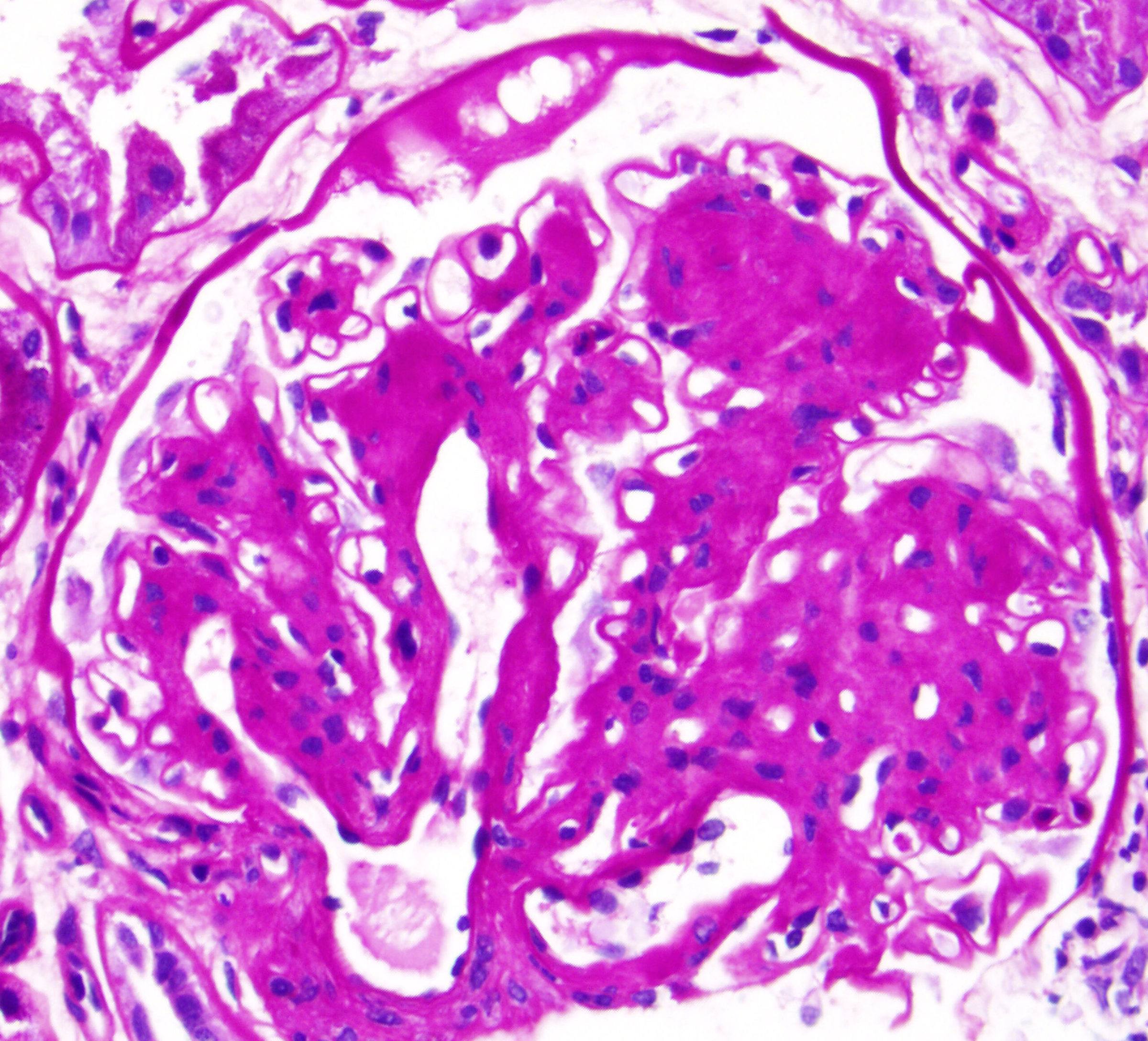 diabetes mellitus light microscopy scan