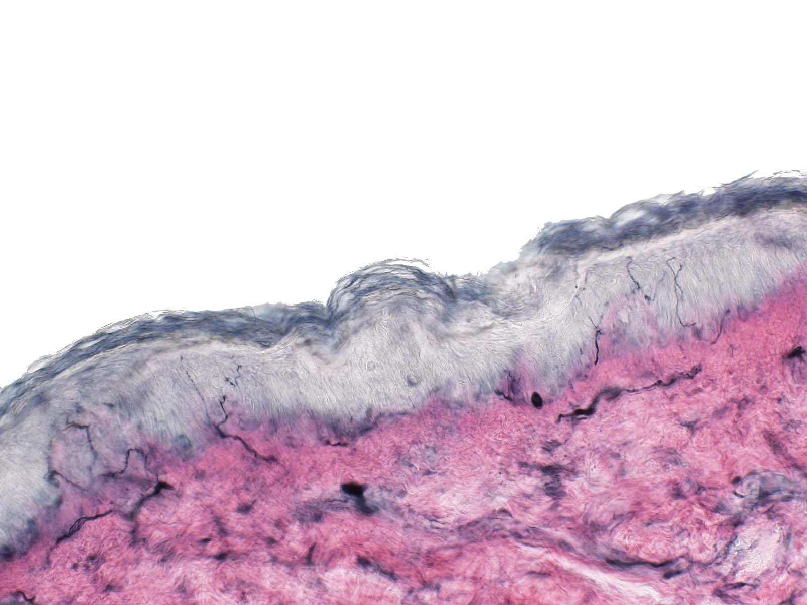 epidermal nerve fiber density image showing small fiber neuropathy
