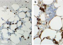 Bone marrow biopsy. Immunohistochemistry showing plasma cells staining for CD138 (a) and IgA (b) (original magnification ×200 for [a] and ×400 for [b]).
