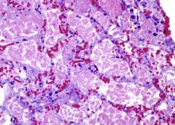 Necrotic tissue with ghost outlines of glomeruli and tubules with loss of cellular detail