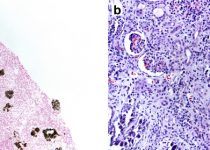 Kidney biopsy specimen