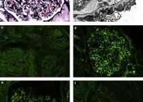 Renal biopsy findings in membranous-like glomerulopathy with masked IgG κ deposits