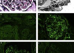 Renal biopsy findings in membranous-like glomerulopathy with masked IgG κ deposits