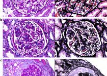 Morphologic spectrum in membranous glomerulopathy with light chain−restricted deposits.