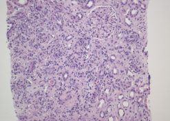 Polyomavirus Nephropathy in Autologous Stem Cell Transplantation publication figure