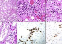 Acute tubular injury and immune cell infiltration in coronavirus disease 2019 kidneys