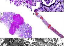 Collapsing glomerulopathy. (A, B) Collapse of the glomerular tuft associated with prominent epithelial cell hyperplasia and hypertrophy