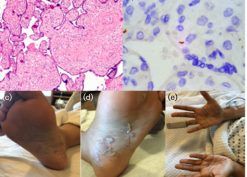 Pathology of the placenta