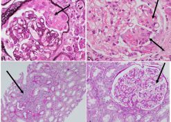 Representative photomicrographs of glomerular changes consistent with pauci-immune focal necrotizing and crescentic glomerulonephritis