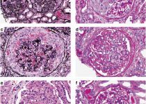 Light microscopy findings in endocarditis-associated glomerulonephritis