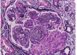 Glomerulus showing nodular mesangial expansion that is weekly Silver positive, one cellular crescent and rare intracapillary neutrophils. (Jones Silver stain 400×)