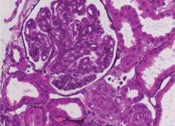 Renal biopsy one week after initiation of bortezomib therapy showing complete arteriolar luminal obliteration by endothelial swelling, fibrous and mucoid intimal thickening, and an ischemic glomerulus with a bloodless appearance.