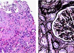 Hypertension-associated thrombotic microangiopathy