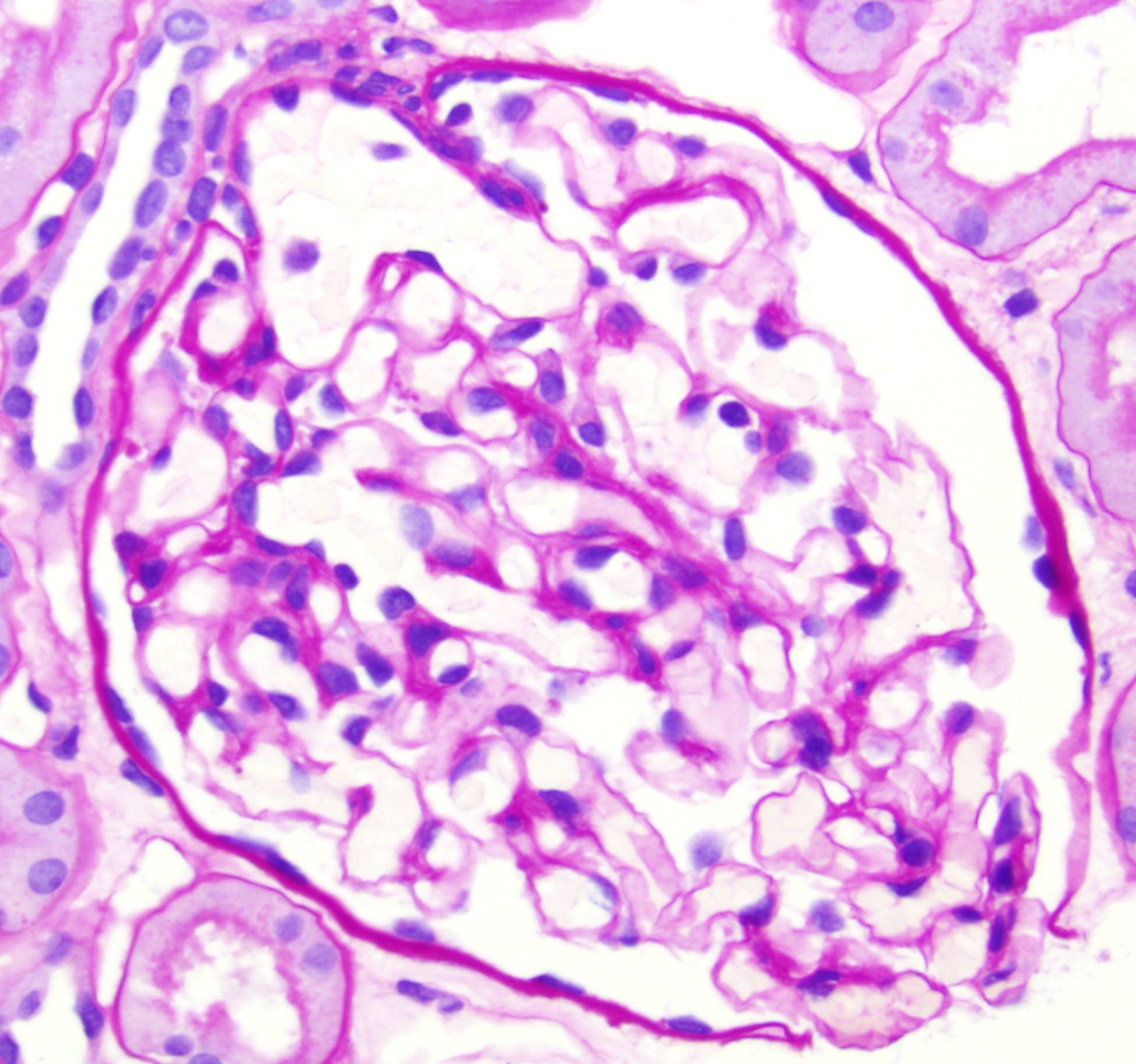 fsgs, Focal Segmental Glomerulosclerosis, glomerulus, diabetes mellitus