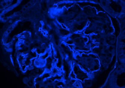 blue stain of glomerulus from a renal biopsy sent to arkana laboratories