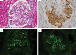 Pathologic findings on LM and IF