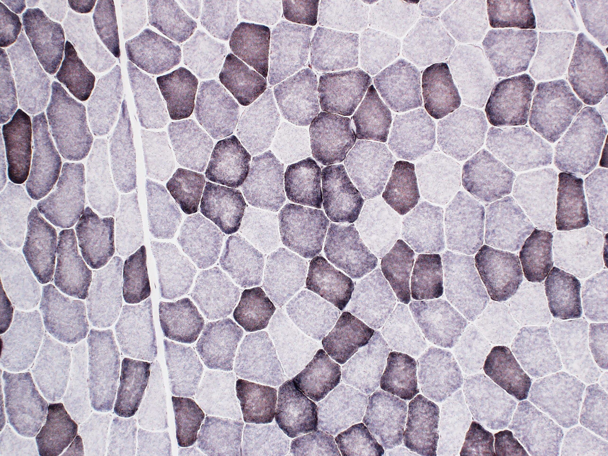 diagnostic image of nerve biopsy sent to arkana laboratories