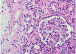 thrombotic microangiopathy