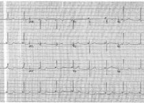 Electrocardiogram with short PR interval and delta wave