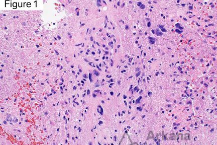 IDH-Wildtype Glioblastoma