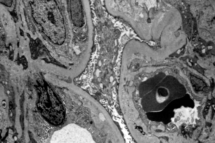 chronic endothelial injury, chronic tma