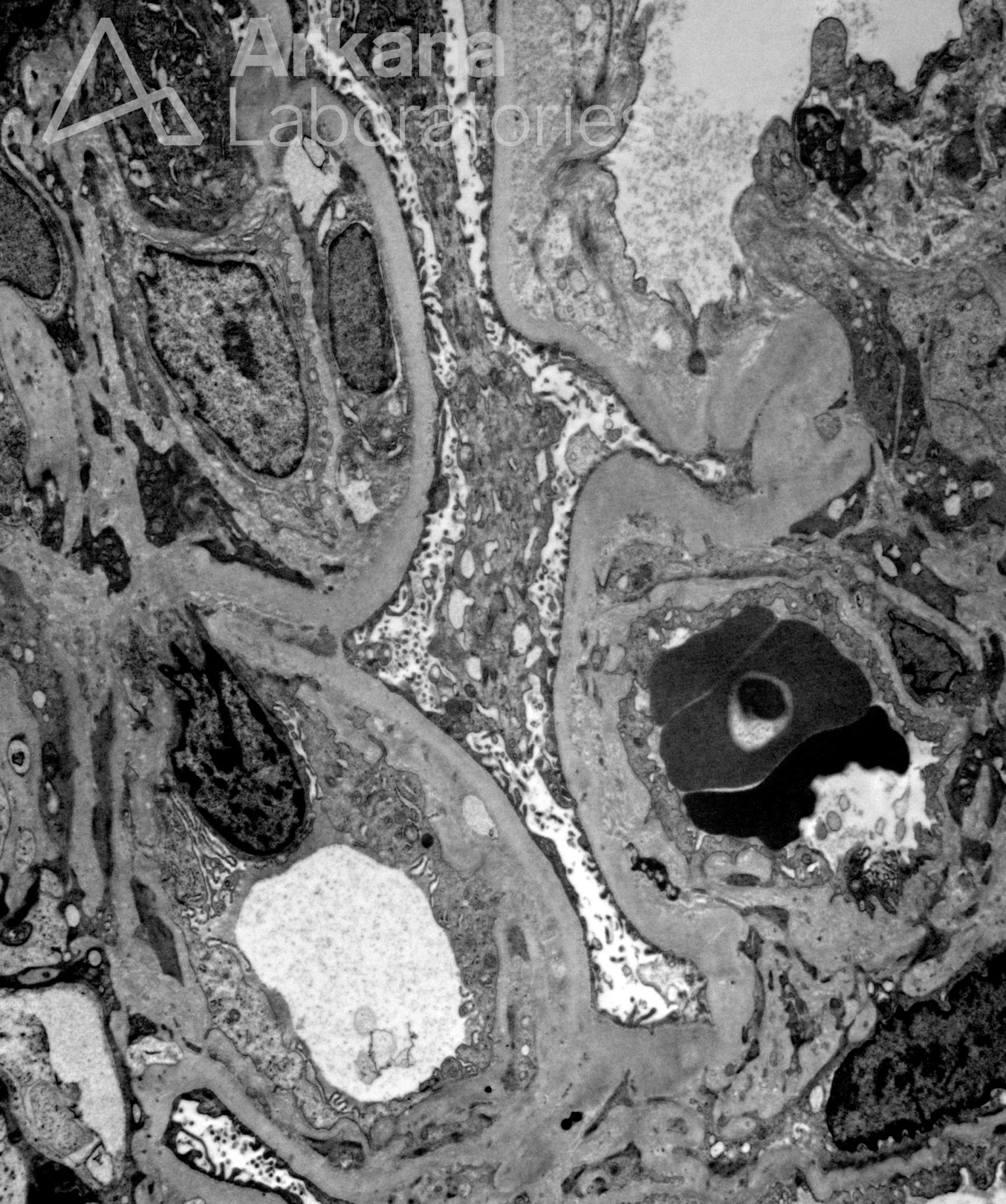 chronic endothelial injury, chronic tma