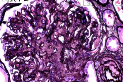 fibrillary glomerulopathy (FGN)