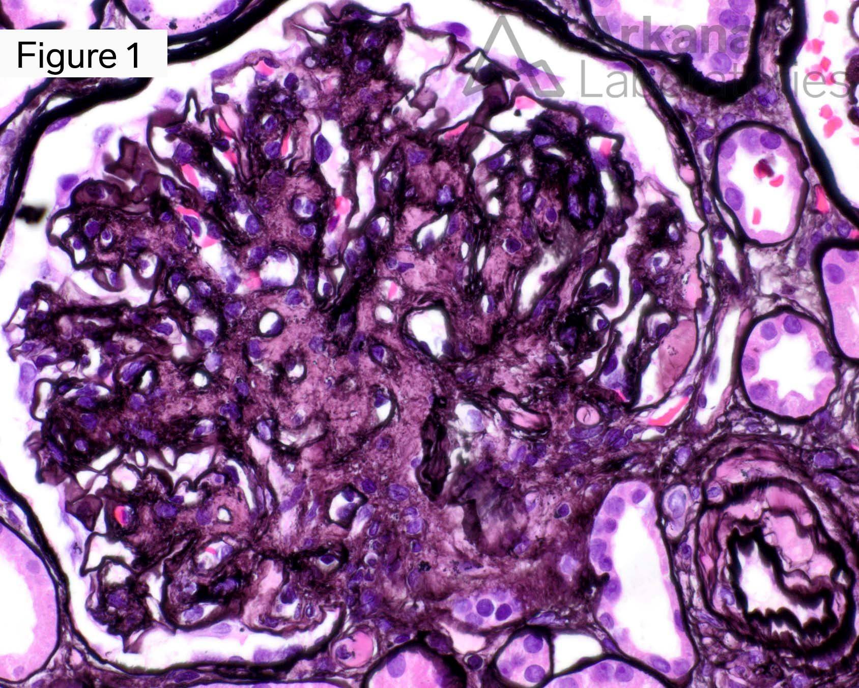 fibrillary glomerulopathy (FGN)