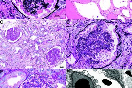 COVAN, anti-nephrin antibodies in MCD