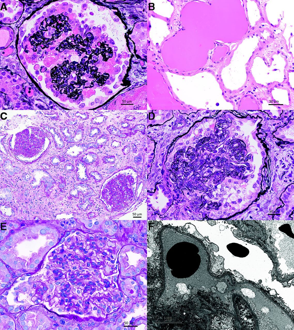 COVAN, anti-nephrin antibodies in MCD