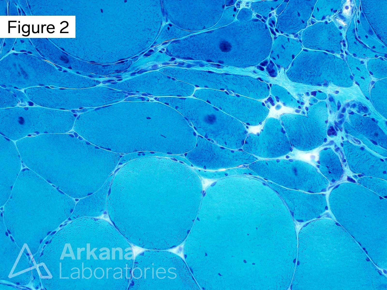 Modified Gomori Trichrome stained section shows multiple acutely angulated atrophic muscle fibers