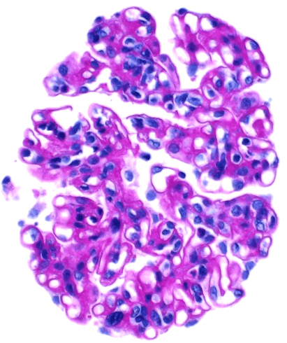 large glomerulus on PAS stain