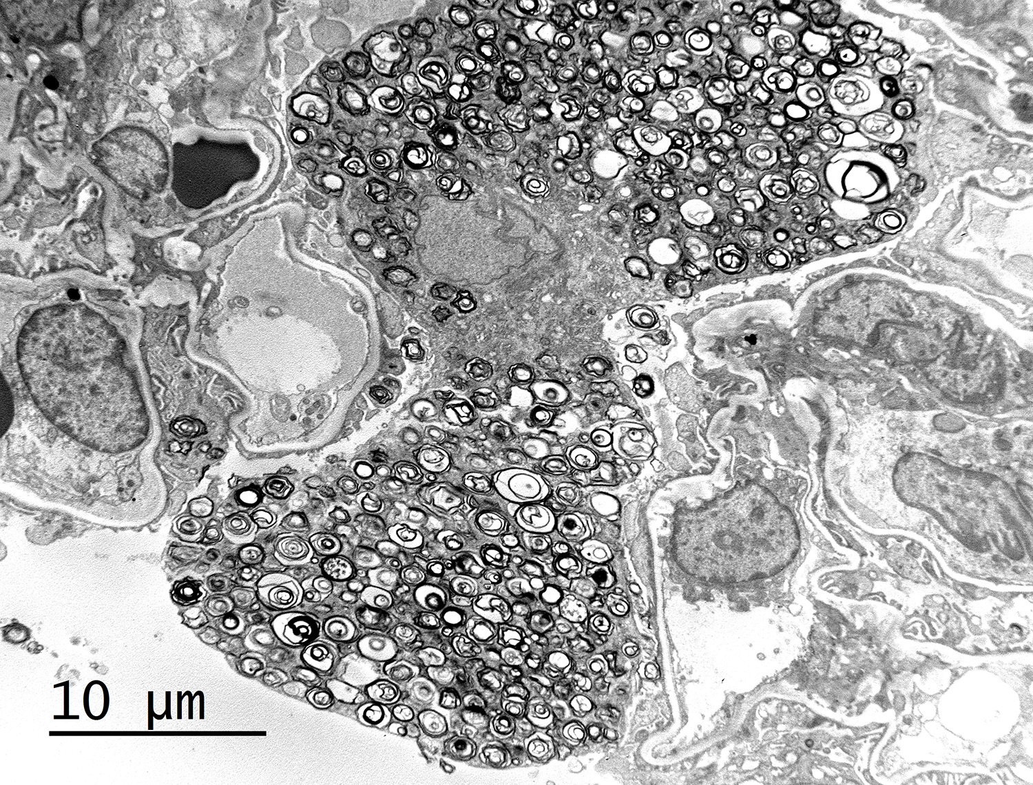 EM image taken from renal biopsy at arkana laboratories