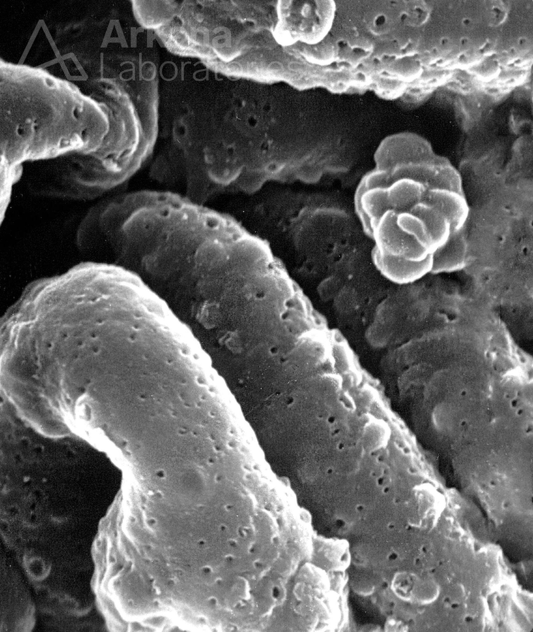 Membranous Glomerulonephritis Stage I